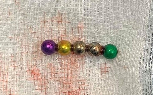 5 viên nam châm xếp hình châm được lấy ra khỏi ruột bé gái 1 tuổi