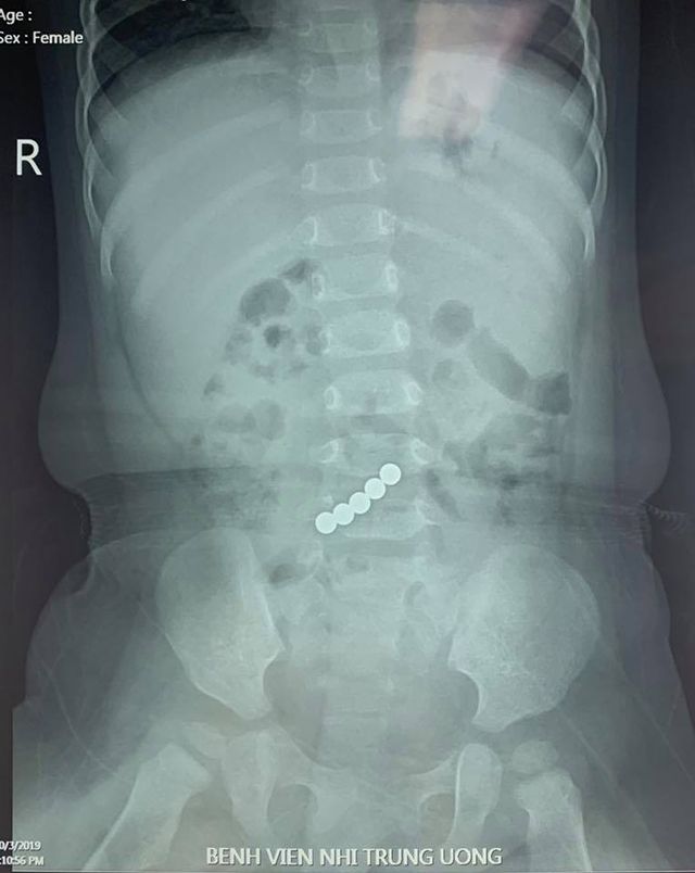Phim X-Quang bụng phát hiện thấy 5 dị vật hình tròn